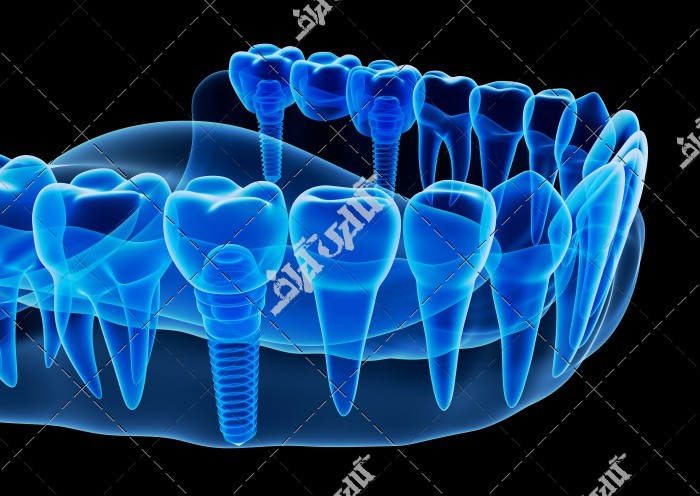 عکس رادیولوژی از دهان و ایمپلنت دندان