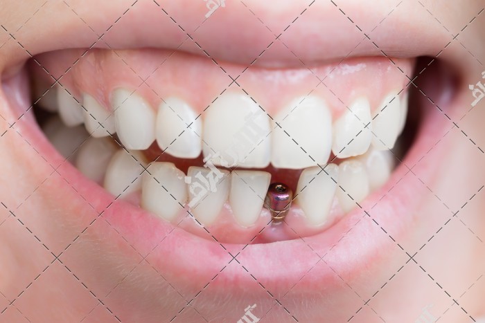 عکس پایه های آهنی ایمپلنت دندان