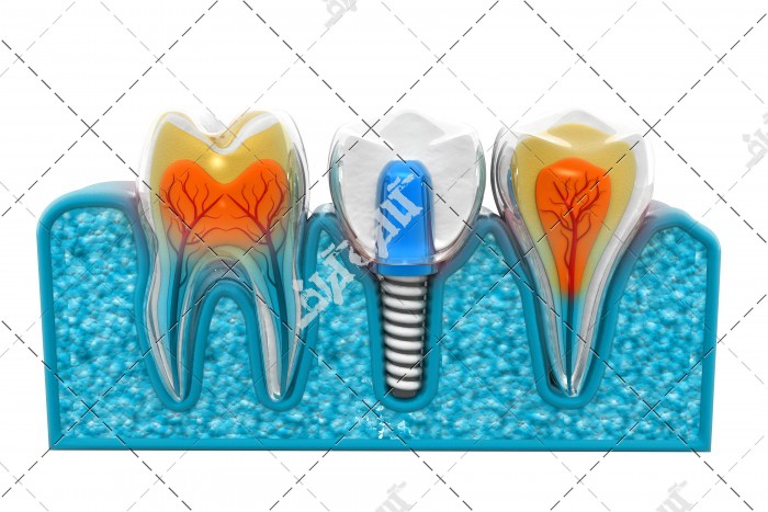 عکس دندان طبیعی و دندان مصنوعی