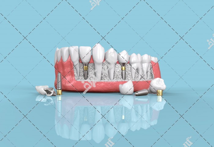 عکس قالب دندان طبیعی و مصنوعی
