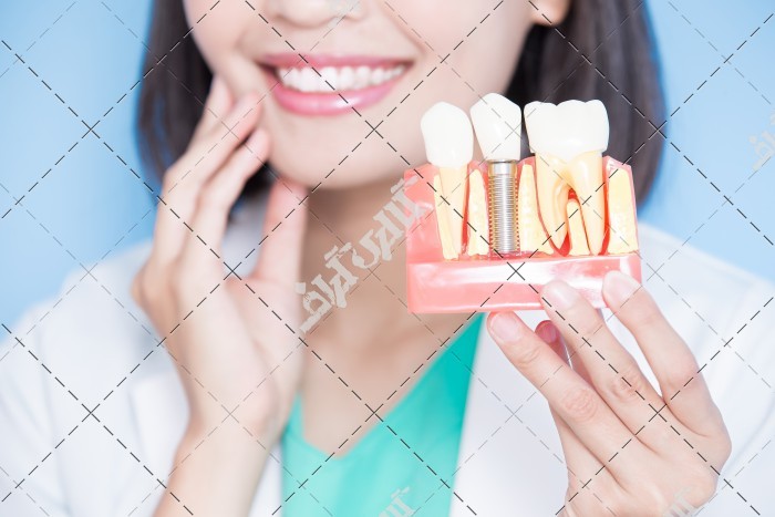 عکس قالب دندان مصنوعی و ایمپلنت و دندان طبیعی