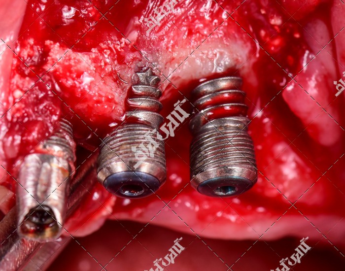 عکس پایه های آهنی دندان و ایمپلنت داخل لثه و دهان