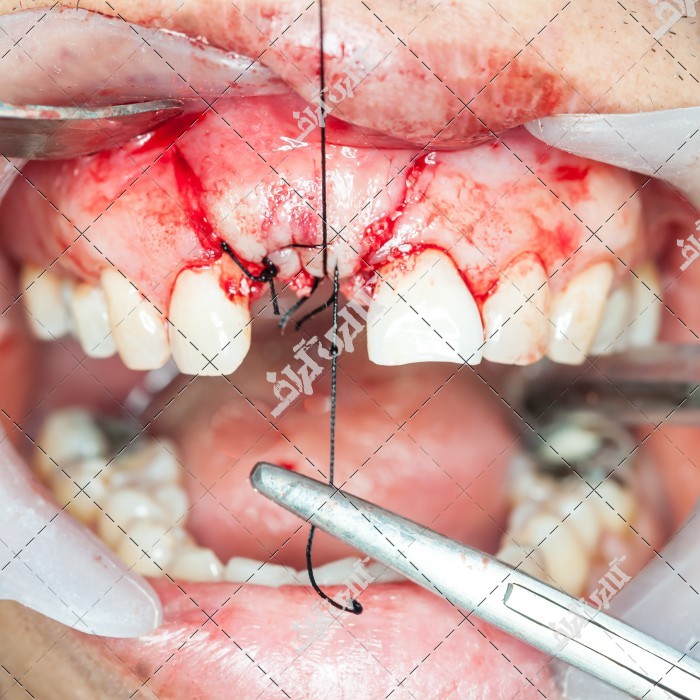 عکس جراحی دندان و نخ و بخیه