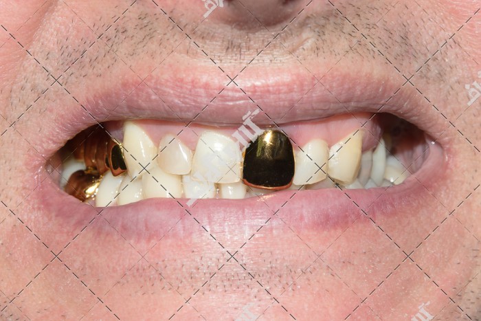 عکس دندان طلا و دندان طبیعی