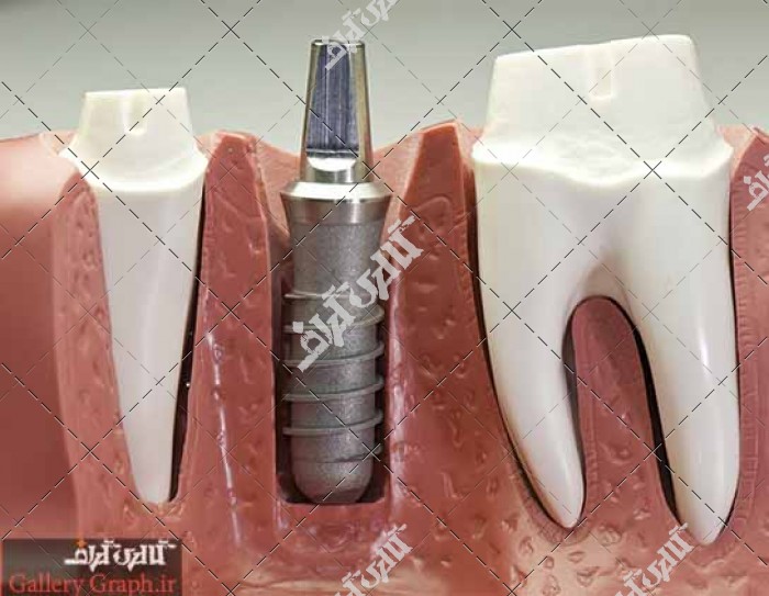 تصویر باکیفیت دندان و ایمپلنت