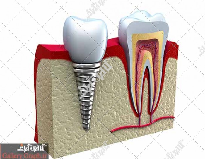 تصویر باکیفیت کاشت دندان و ایمپلنت