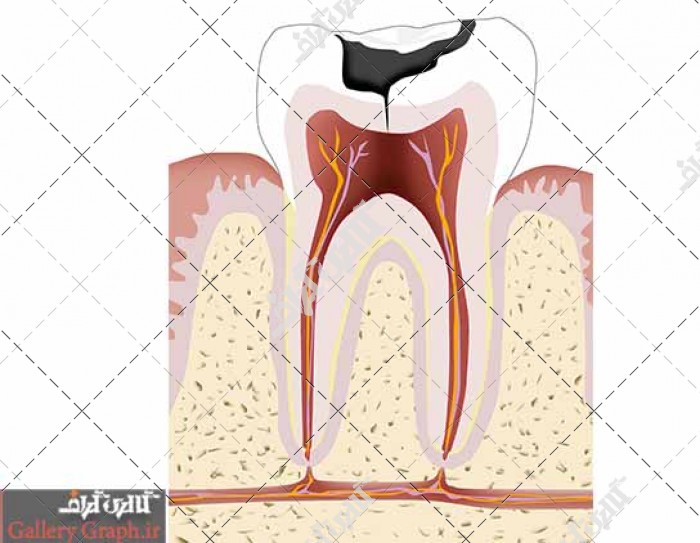 تصویر باکیفیت پوسیدگی دندان و ریشه و عصب دندان