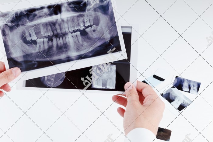 تصویر باکیفیت از عکس اشعه ایکس از دندان